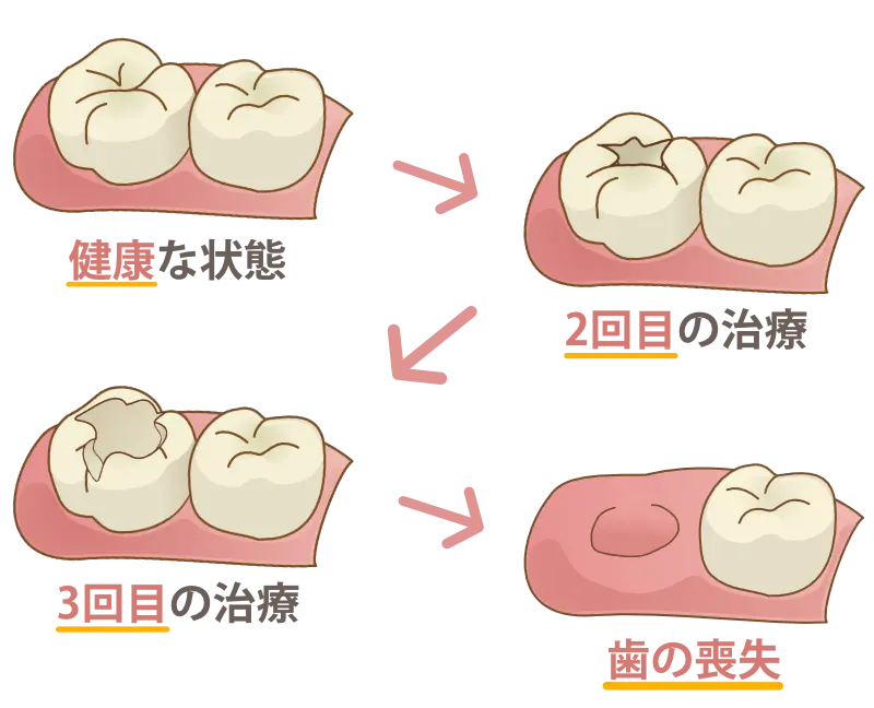健康な状態から歯の喪失までの過程